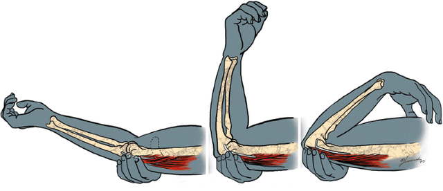 Snapping Triceps Syndrome | Fitness Documentation
